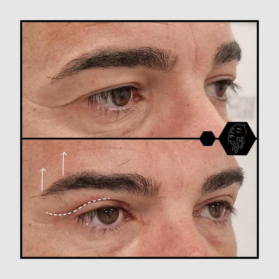 Antes y después de lifting de cejas, paciente de la clínica