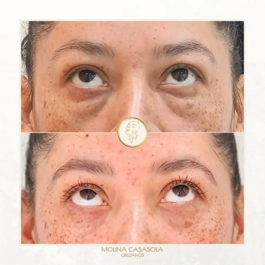 Antes y después de blefaroplastia inferior, paciente de la clínica