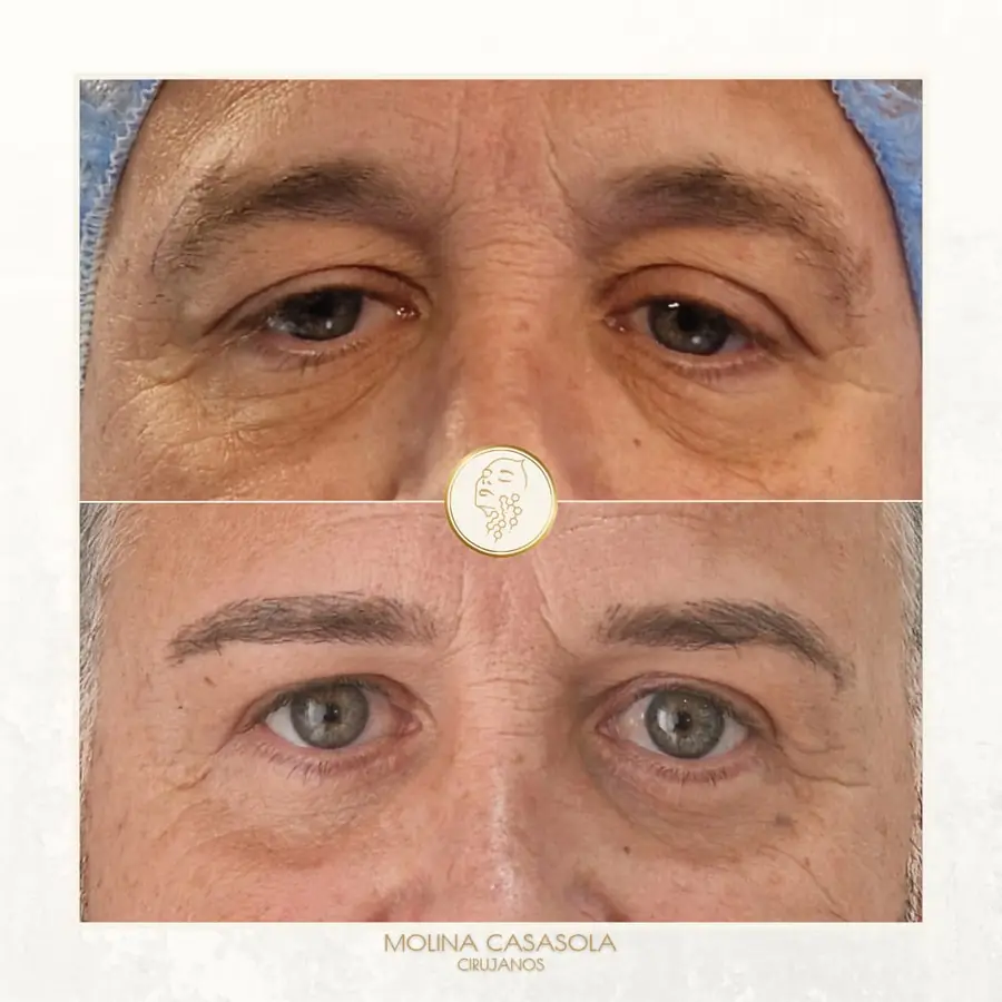 Antes y después de lifting de cejas, paciente de la clínica